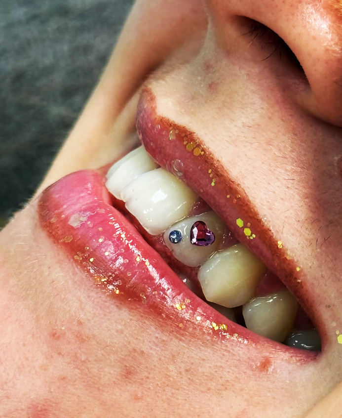 Realmente cuánto tiempo duran puestas las gemas dentales