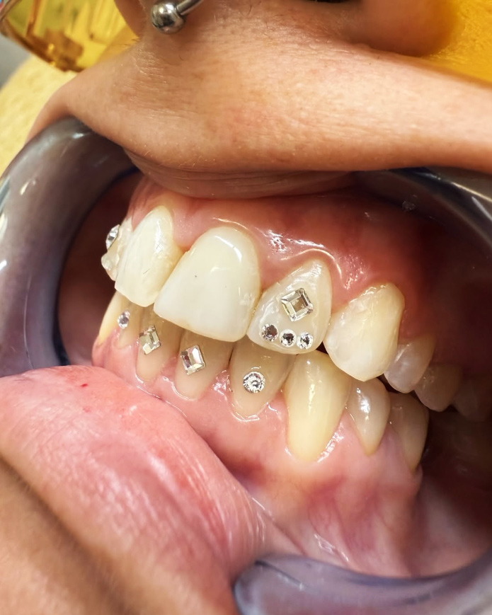 Aprende a poner Gemas Dentales y dale ese toque brillante a las sonrisas de la gente