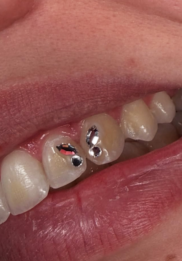 La evolución del mercado 2026 - Adiós al pegamento hola a la odontología estética