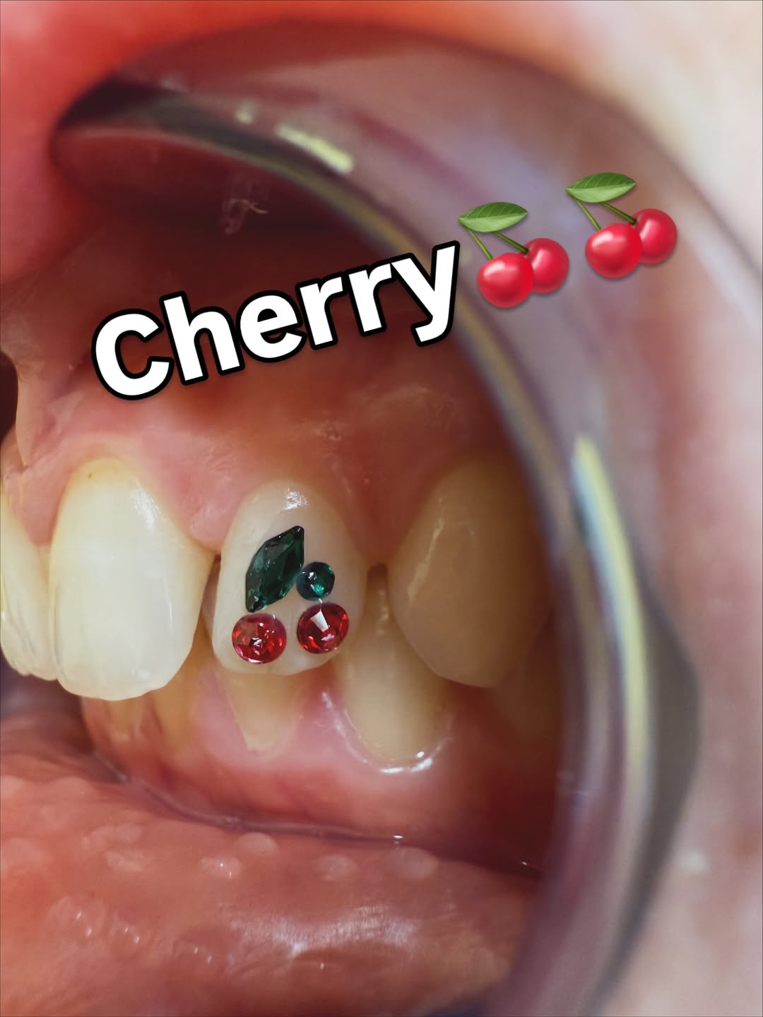 Ana se atreve a brillar - Ana ha elegido unas gemas dentales en forma de cereza, perfectas